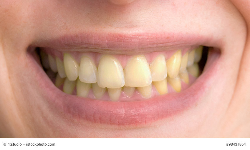 Trubes Lacheln Warum Zahne Den Glanz Verlieren Information Mundgesundheit
