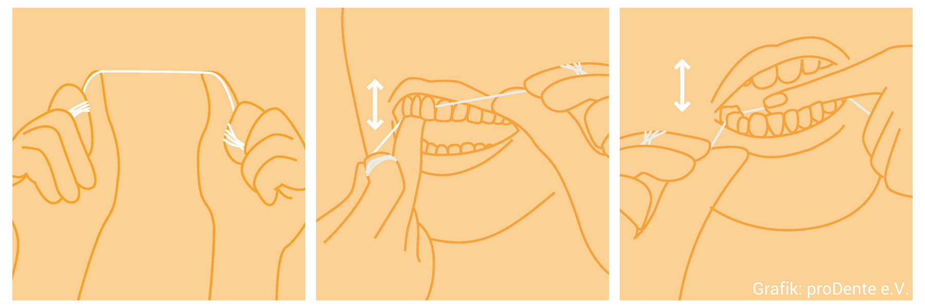 Die Grafik von Prodente e. V. zeigt die Nutzung von Zahnseide.