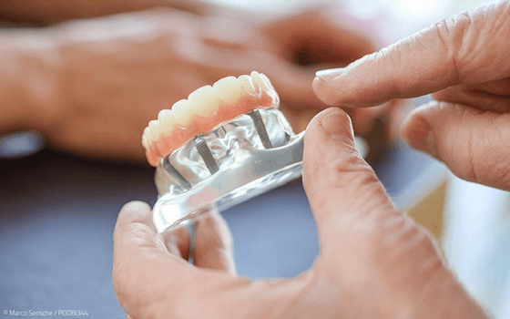 Zahnarzt und Implantologe erklärt Zahnimplantate für den zahnlosen Kiefer